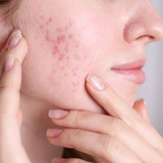 Pigmentation